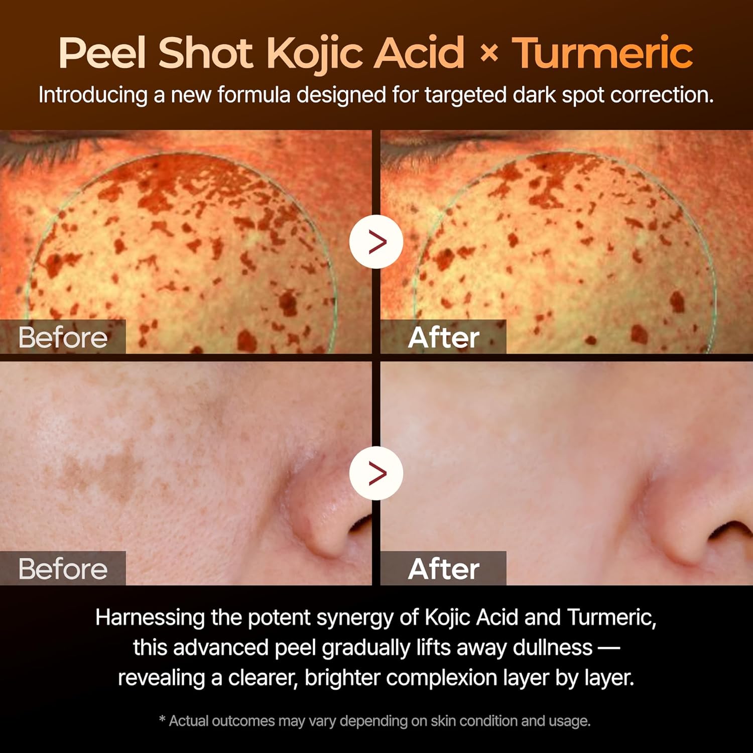 Dr. Melaxin Peel Shot Exfoliating Kojic Acid Turmeric Serum 80ml by Dr.Melaxin – Serum & Ampoule