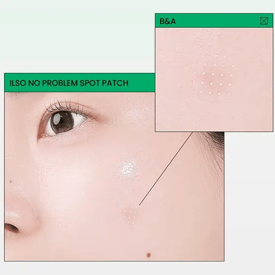 ilso No Problem Spot Patch 72P by ilso – Pimple Patch
